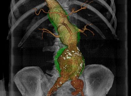 Ricostruzione tridimensionale dell'aneurisma dell'aorta toracica e addominale