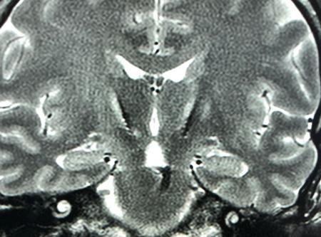 Eseguito a Belcolle un intervento di stimolazione cerebrale profonda su un paziente affetto da malattia di Parkinson