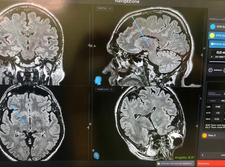 Malattia di Parkinson, Asl Viterbo: "Impiantato su un paziente a Belcolle il primo sistema di elettrocateteri direzionali per la stimolazione cerebrale profonda"