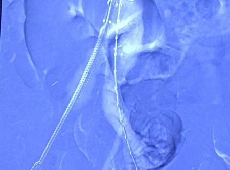 Asl Viterbo: A Belcolle primo intervento di chirurgia endovascolare aortica "Zero contrast"